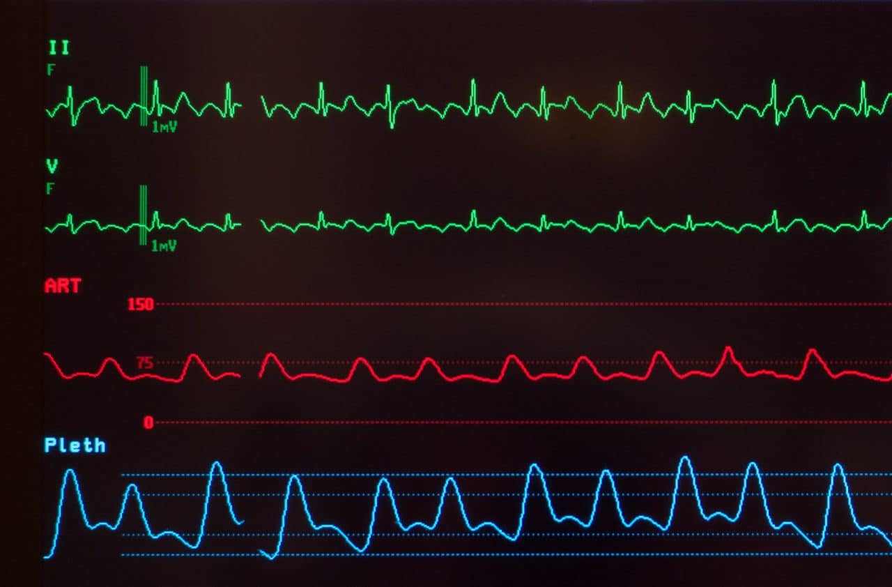 Atrial Flutter Causes Symptoms Diagnosis And Treatment 8836